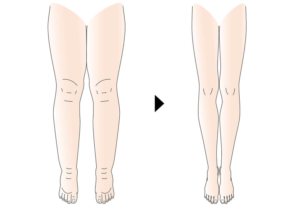 女性特有のむくみ